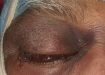 म्युकरमायकोसीस आजारावरील इंजेक्शनच्या १ लाख व्हायल्स राज्य शासन खरेदी करणार