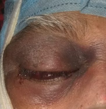 म्युकरमायकोसीस आजारावरील इंजेक्शनच्या १ लाख व्हायल्स राज्य शासन खरेदी करणार