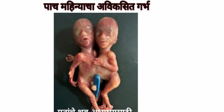 दुर्मिळ घटनेत, विवाहितेने दिला अविकसित सयामी जुळ्यांना जन्म !
