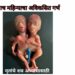 दुर्मिळ घटनेत, विवाहितेने दिला अविकसित सयामी जुळ्यांना जन्म !